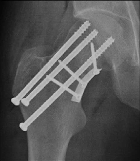 what is medial buttress